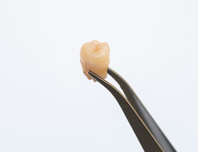 Although Rare, This Condition Could Destroy a Tooth